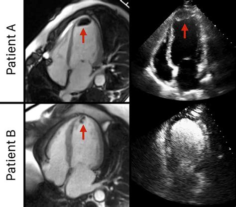 lv thrombus echo|left ventricular thrombus after heart attack.